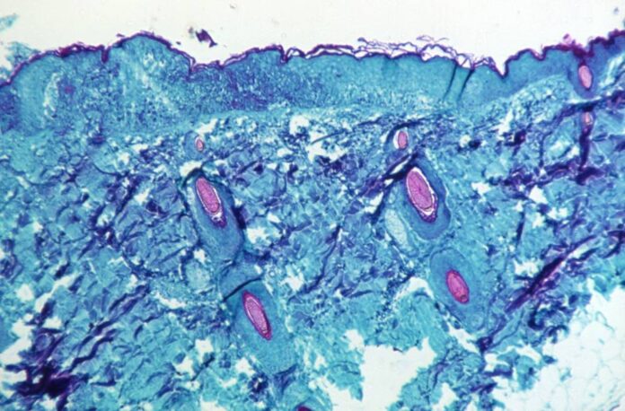Roche develops monkeypox PCR tests