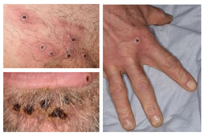 WHO emergency committee decides on monkeypox outbreak