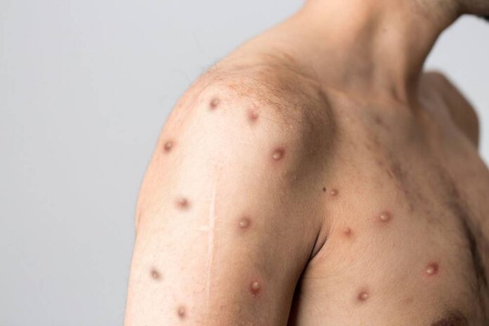 'Crying all the time': Monkeypox patients reveal psychological scars